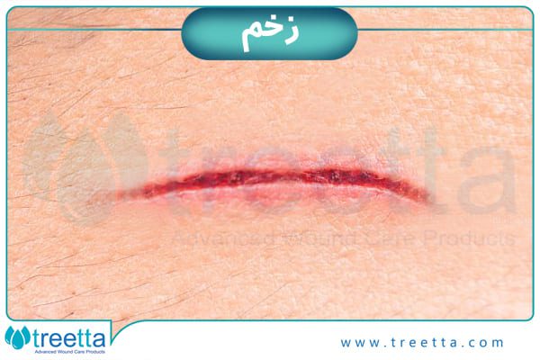 درمان زخم در تریتا